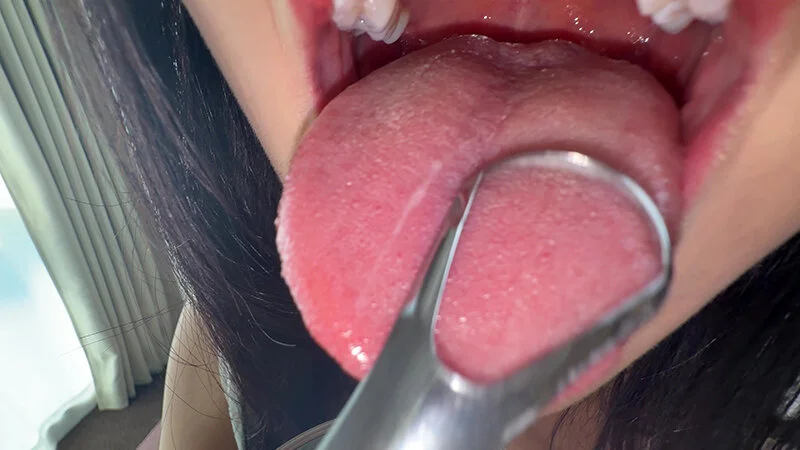 【個人撮影】桃瀬まゆの舌ブラシで「汚舌苔」採取-8