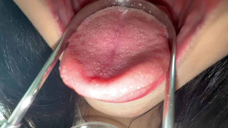 【個人撮影】桃瀬まゆの舌ブラシで「汚舌苔」採取-10